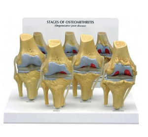 (미국GPI)4단계 관절염(G110)/ 4-Stage Osteoarthritis Knee 110