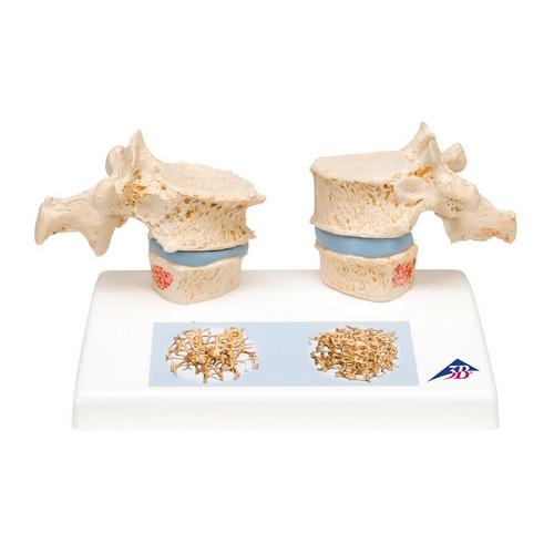 [3B] A95 골다공증모형 / Osteoporosis Model