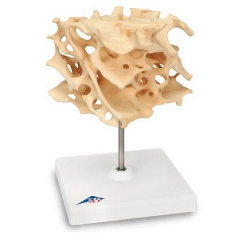 [3B] A99 (해면모양의 뼈) 100번확대 암세포로덮인 뼈모형 / Cancellous Bone