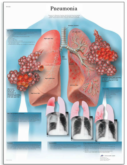 [3B]폐렴차트 감염된폐방사선사진차트 Pneumonia Chart /50 x 67 cm VR1326UU(비코팅)