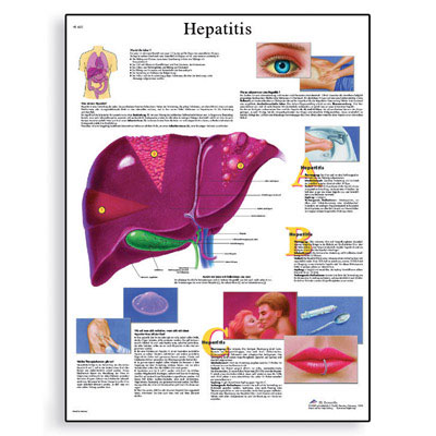 [독일3B] 간염차트 A형, B형, C형 간염 VR1435L(코팅) Hepatitis Chart