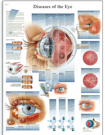 [독일3B] 안구 질병차트 안구질환 VR1231L(코팅) Diseases of the Eye Chart